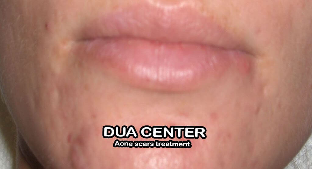 How to remove dark spots dua wazifa to remove acne scars Daagh